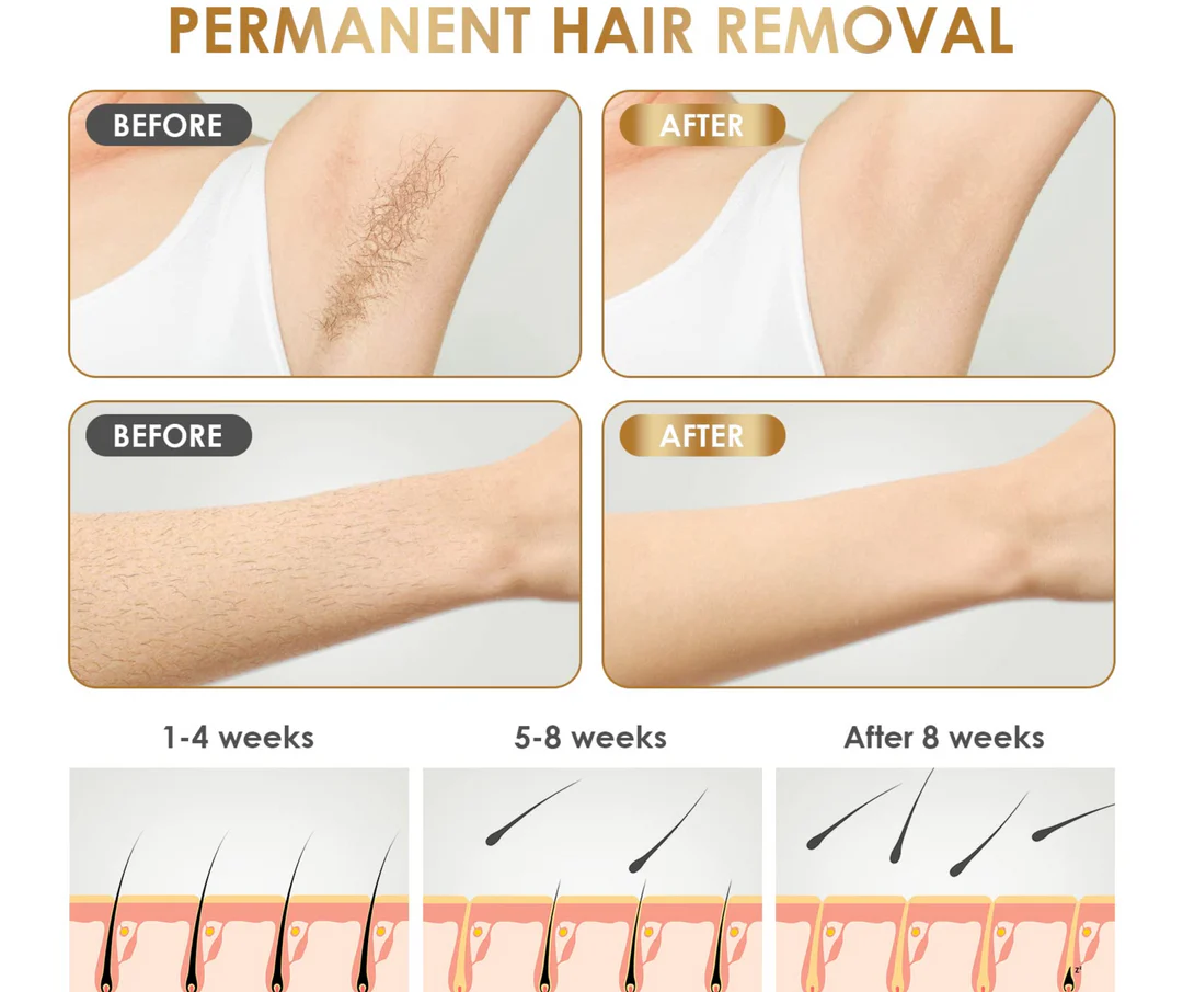 IPL Laser Hair Removal | The Leading At-Home Solution for Smooth Skin